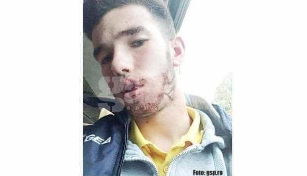 Copil desfigurat în urma  unui meci de fotbal la Piteşti