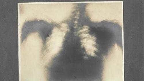 Radiografia lui Brătianu va fi expusă la muzeul din Ștefănești, după 112 ani de la atentat