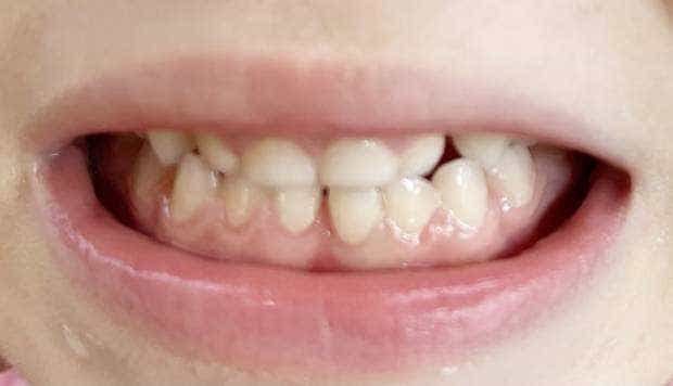Clinica de medicină dentară Dr. TEO – Zâmbim oricând împreună! SIGILAREA DINŢILOR
