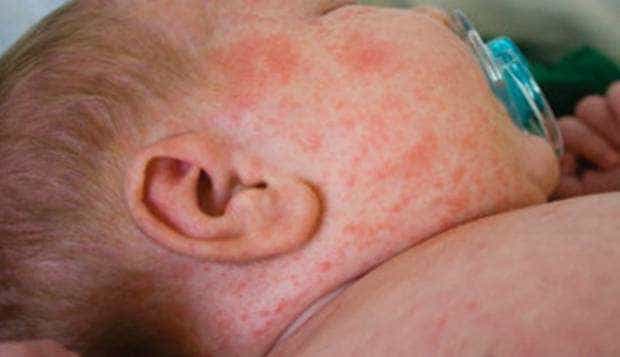 Sute de bebeluși nu beneficiază de vaccinul rujeolic-rubeolic-oreion