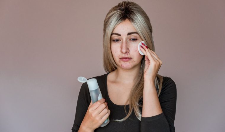 4 lucruri pe care trebuie să le știi despre acnee