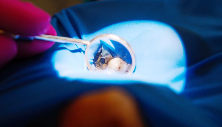 Clinica de medicină dentară Dr. TEO – Zâmbim oricând împreună! Măseaua de minte