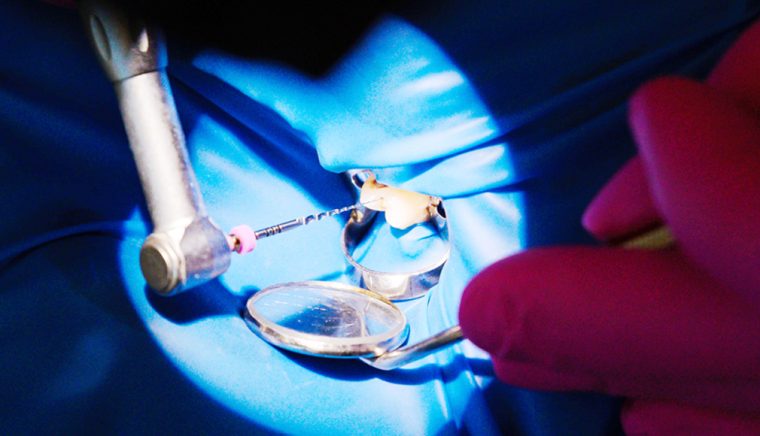 Clinica de medicină dentară Dr. TEO – Zâmbim oricând împreună! Coroanele dentare